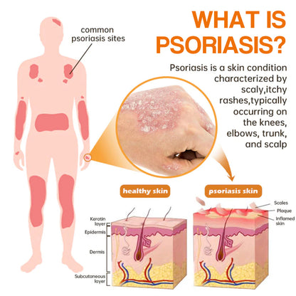 (🔥2X1 paquete del último día 🔥) LOVILDS™ PSORIAHEAL PSORIASIS SPRAY PRO🐝