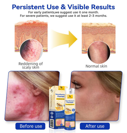 (🔥2X1 paquete del último día 🔥) LOVILDS™ PSORIAHEAL PSORIASIS SPRAY PRO🐝
