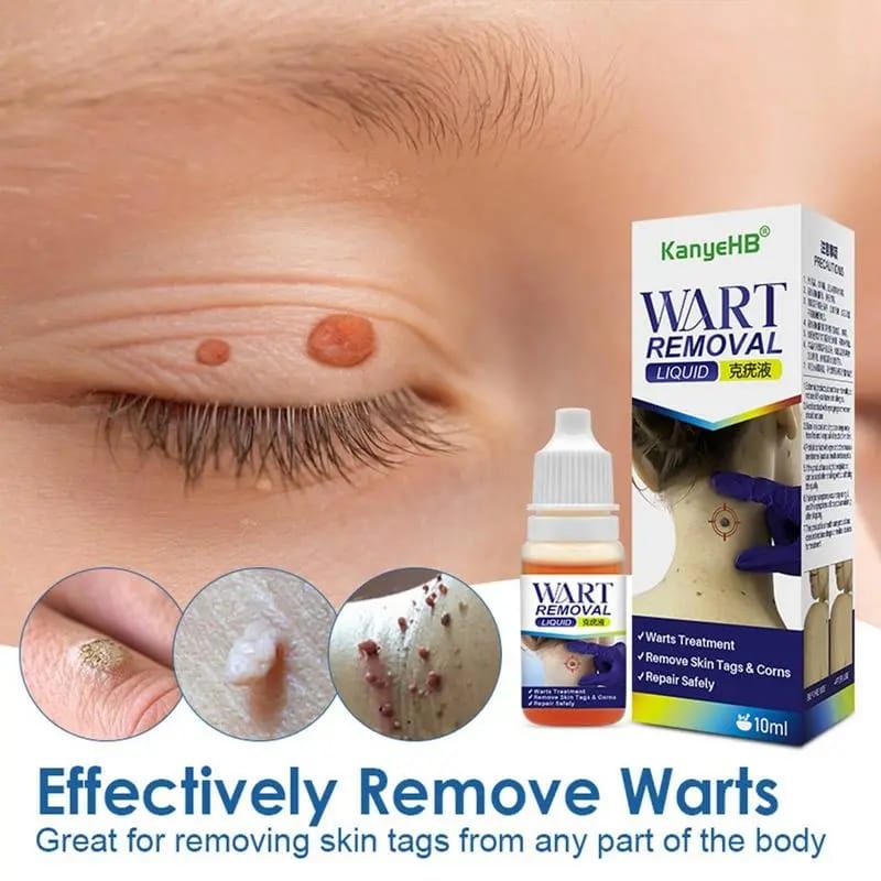 🌿WART REMOVAL LIQUID⭐⭐⭐⭐⭐QUITA VERRUGAS LIQUIDO😱