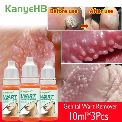 🌿WART REMOVAL LIQUID⭐⭐⭐⭐⭐QUITA VERRUGAS LIQUIDO😱